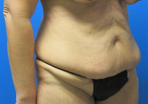 Tummy Tuck Before and After | SGK Plastic Surgery