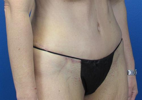 Tummy Tuck Before and After | SGK Plastic Surgery