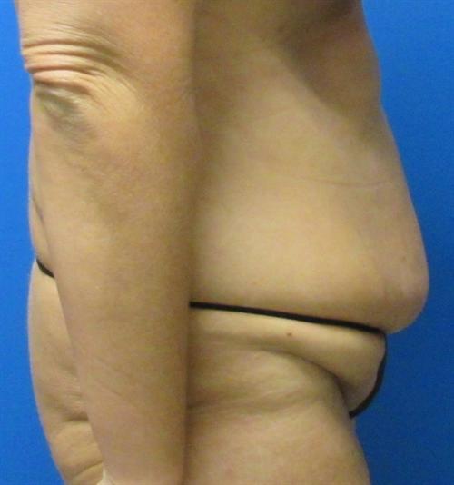 Tummy Tuck Before and After | SGK Plastic Surgery