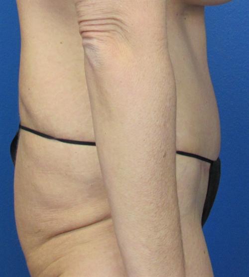 Tummy Tuck Before and After | SGK Plastic Surgery
