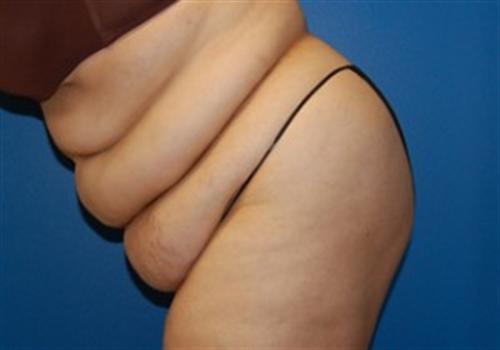 Tummy Tuck Before and After | SGK Plastic Surgery