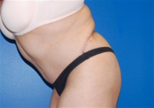 Tummy Tuck Before and After | SGK Plastic Surgery
