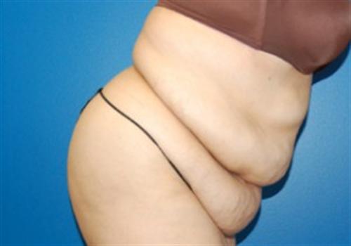 Tummy Tuck Before and After | SGK Plastic Surgery