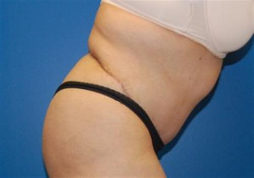 Tummy Tuck Before and After | SGK Plastic Surgery