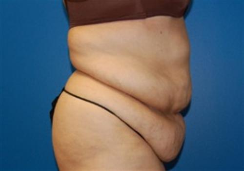 Tummy Tuck Before and After | SGK Plastic Surgery