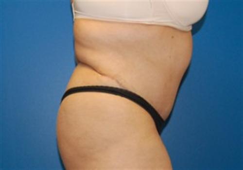 Tummy Tuck Before and After | SGK Plastic Surgery