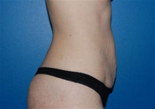 Tummy Tuck Before and After | SGK Plastic Surgery