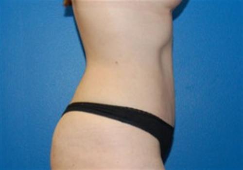 Tummy Tuck Before and After | SGK Plastic Surgery