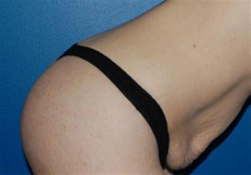 Tummy Tuck Before and After | SGK Plastic Surgery