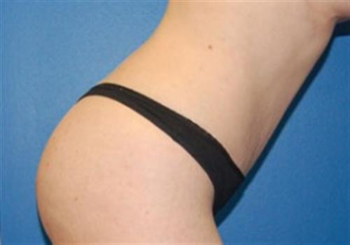 Tummy Tuck Before and After | SGK Plastic Surgery
