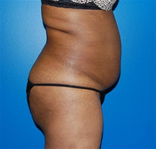Tummy Tuck Before and After | SGK Plastic Surgery