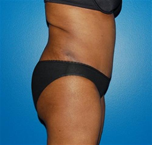 Tummy Tuck Before and After | SGK Plastic Surgery