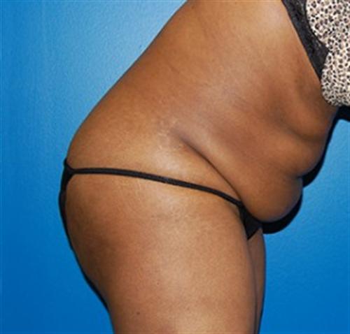 Tummy Tuck Before and After | SGK Plastic Surgery