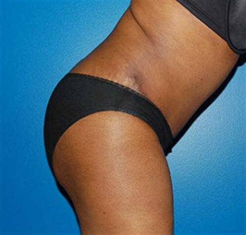Tummy Tuck Before and After | SGK Plastic Surgery