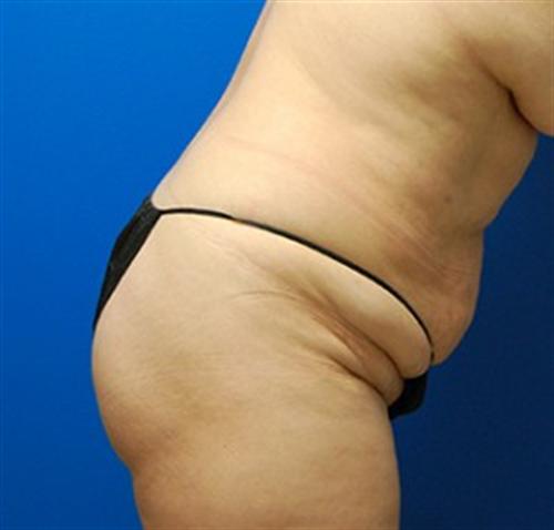 Tummy Tuck Before and After | SGK Plastic Surgery