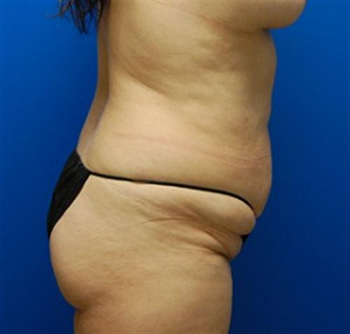 Tummy Tuck Before and After | SGK Plastic Surgery