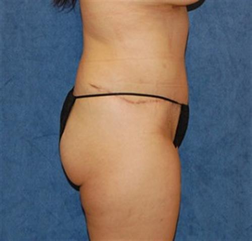 Tummy Tuck Before and After | SGK Plastic Surgery