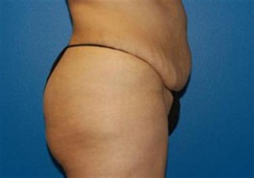 Tummy Tuck Before and After | SGK Plastic Surgery