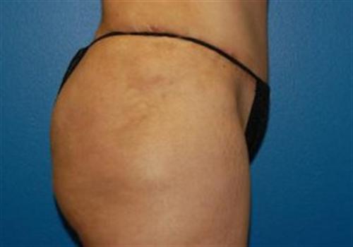 Tummy Tuck Before and After | SGK Plastic Surgery