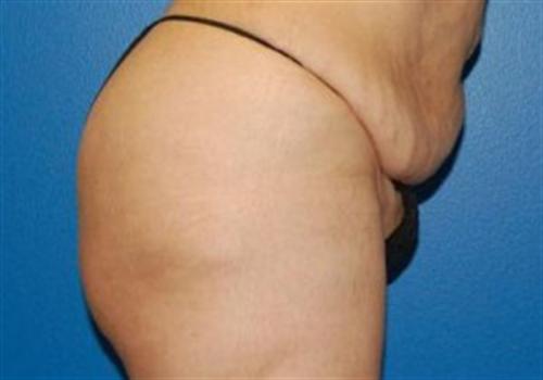 Tummy Tuck Before and After | SGK Plastic Surgery