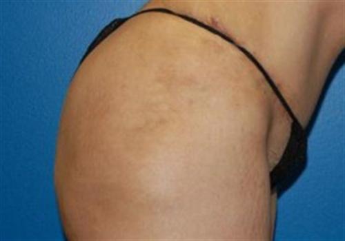 Tummy Tuck Before and After | SGK Plastic Surgery