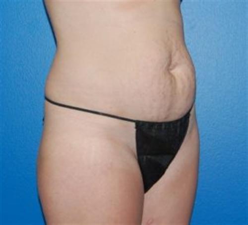Tummy Tuck Before and After | SGK Plastic Surgery