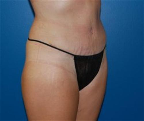 Tummy Tuck Before and After | SGK Plastic Surgery