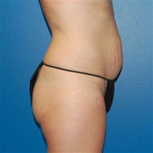Tummy Tuck Before and After | SGK Plastic Surgery
