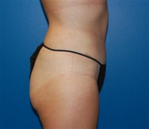 Tummy Tuck Before and After | SGK Plastic Surgery