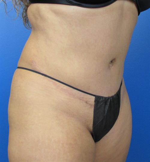 Tummy Tuck Before and After | SGK Plastic Surgery