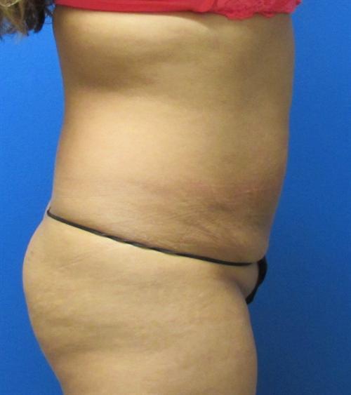 Tummy Tuck Before and After | SGK Plastic Surgery