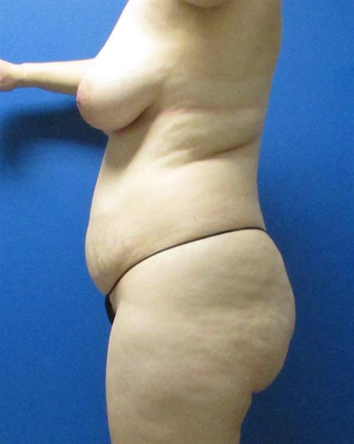 Tummy Tuck Before and After | SGK Plastic Surgery