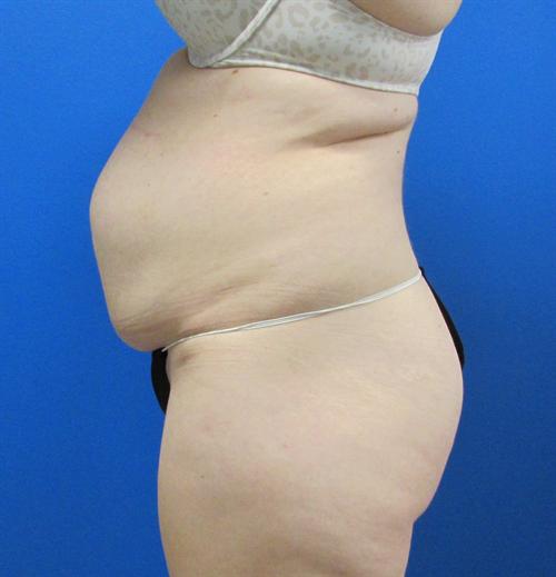 Tummy Tuck Before and After | SGK Plastic Surgery