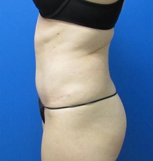 Tummy Tuck Before and After | SGK Plastic Surgery
