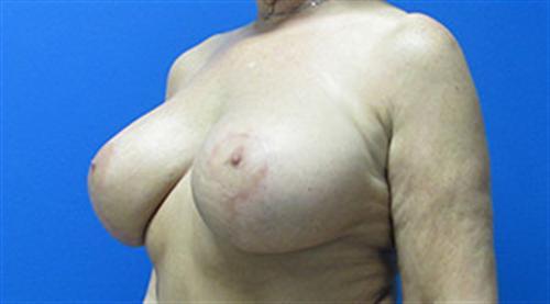 Breast Augmentation Before and After | SGK Plastic Surgery
