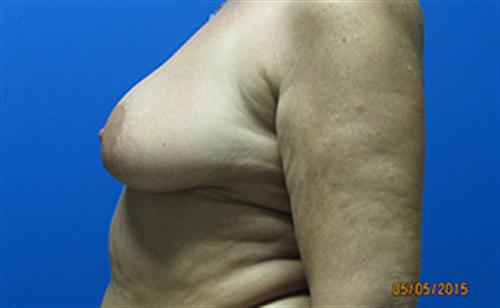 Breast Augmentation Before and After | SGK Plastic Surgery