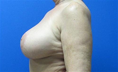 Breast Augmentation Before and After | SGK Plastic Surgery