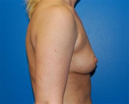 Breast Augmentation Before and After | SGK Plastic Surgery