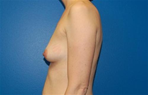 Breast Augmentation Before and After | SGK Plastic Surgery