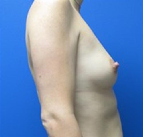 Breast Augmentation Before and After | SGK Plastic Surgery