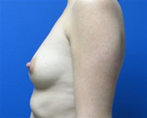 Breast Augmentation Before and After | SGK Plastic Surgery
