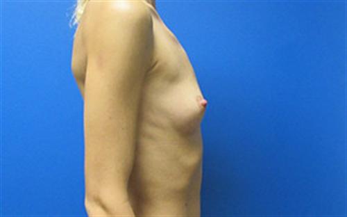Breast Augmentation Before and After | SGK Plastic Surgery