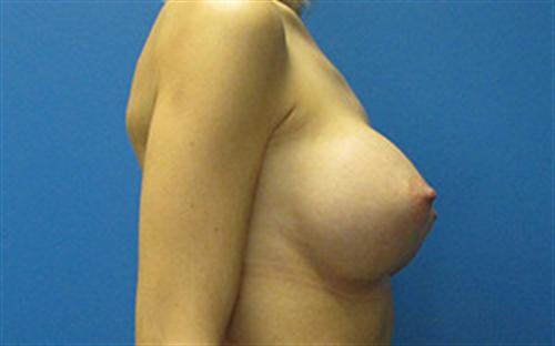 Breast Augmentation Before and After | SGK Plastic Surgery