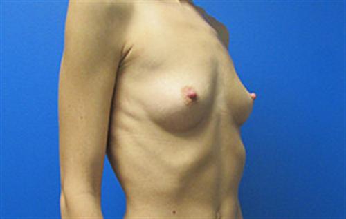 Breast Augmentation Before and After | SGK Plastic Surgery