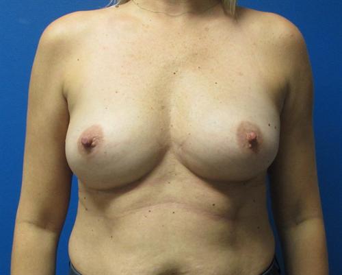 Breast Augmentation Before and After | SGK Plastic Surgery