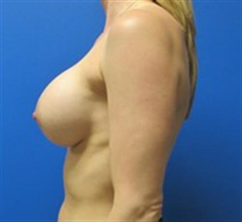 Breast Augmentation Before and After | SGK Plastic Surgery