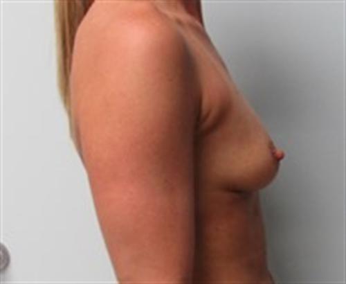 Breast Augmentation Before and After | SGK Plastic Surgery