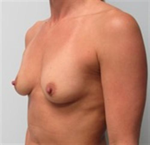 Breast Augmentation Before and After | SGK Plastic Surgery