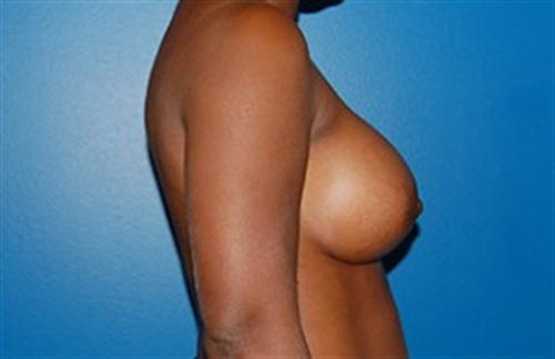 Breast Augmentation Before and After | SGK Plastic Surgery