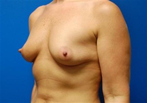 Breast Augmentation Before and After | SGK Plastic Surgery